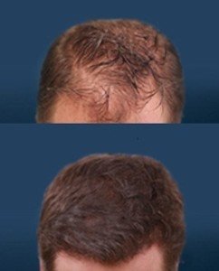 hair-transplant-in-lucknow